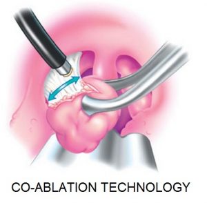 coblation-tonsillectomy-dr-wu-dr-trimble-1024x475